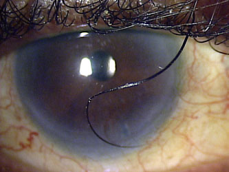 Trichiasis with abnormal lash touching the cornea