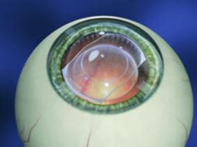  Visian ICL In the Eye 