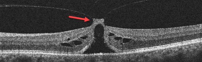 OCT Scan of Vitreomacular Traction