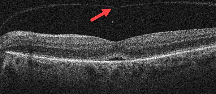 OCT Scan of Separated Vitreous following Jetrea