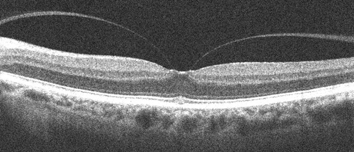 OCT Scan of a Healthy Macula