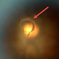 Posterior Vitreous Detachment Example