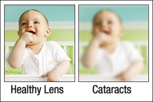 Cataracts vs. healthy eye diagram