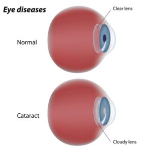Cataract eye diagram