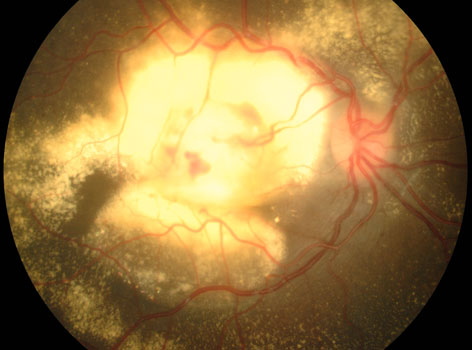 Coats' disease with severe accumulation of yellow lipid under the macula