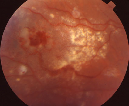 Retinal Hemorrhages caused by Coats' Disease