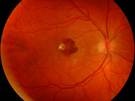 Macula with Idiopathic Choroidal Neovascularization