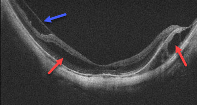 OCT scan of a Macula with Degenerative Myopia