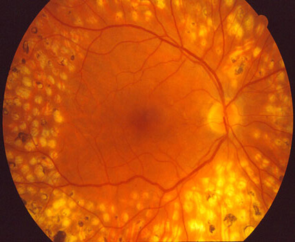 Panretinal Photocoagulation (PRP) Scarring Example 