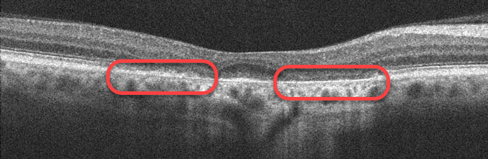 Plaquenil Toxicity Screening In Louisville KY